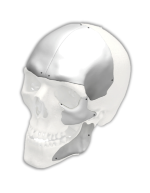 Customized Craniofacial Implants